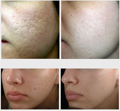 Tixel® uses thermal fractional skin rejuvenation to produce results comparable to co2 laser, plasma plasmage or fibroblast. Effective Acne Scar Treatment For Brides To Be Feel Good ...