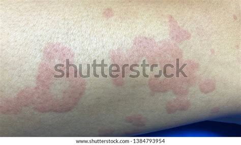 Multiple Wheal Flare Right Thigh Case Stock Photo Edit Now 1384793954