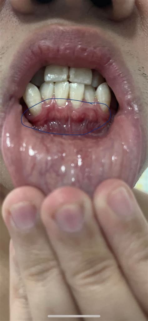 White Spots On Gum No Hurt Raskdentists