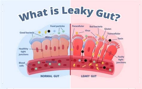 Is Leaky Gut A Real Thing Ibs Celiac Disease Crohns Disease
