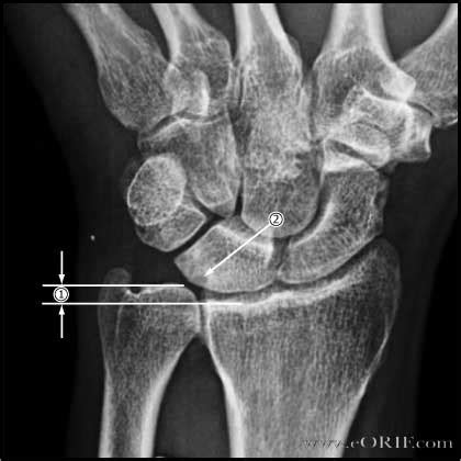 Palmer classification for triangular fibrocartilage complex (tfcc) abnormalities is based on the cause, location, and degree of injury 1: Ulnar Variance | eORIF