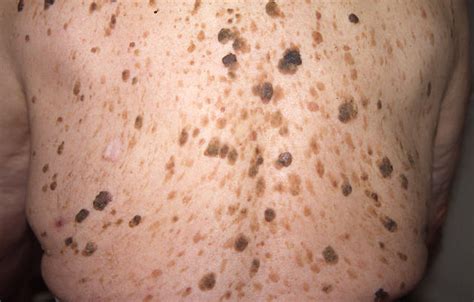 Seborrheic Keratosis A Benign Skin Lesion Seborrheic Keratosis Sexiz Pix