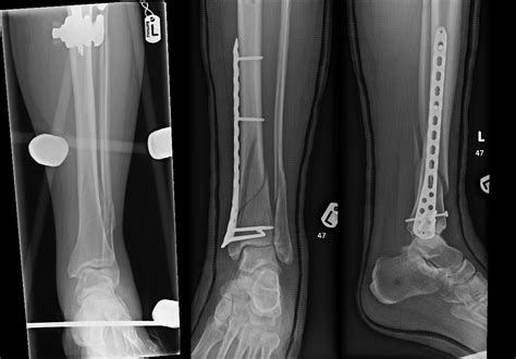 Tibial Fractures Plateau Shaft And Pilon Orthosho