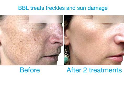 Ipl Treatment For Freckles Before And After Ipl Photofacial Rejuventation Treatment At Camas