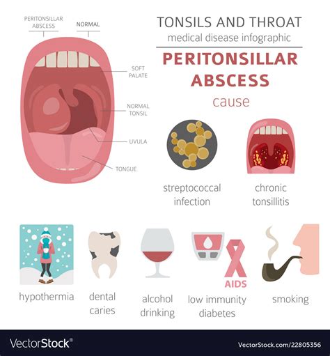 Tonsils And Throat Diseases Peritonsillar Abscess Vector Image The Best Porn Website