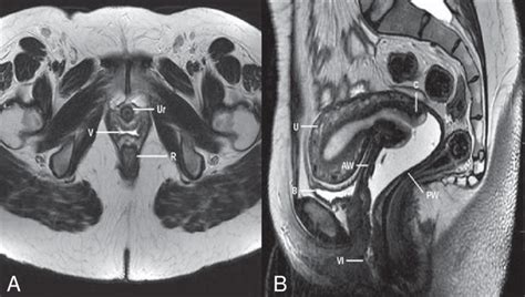 Normal Female Pelvis Axial A And Sagittal B Mri T2 Weighted Images