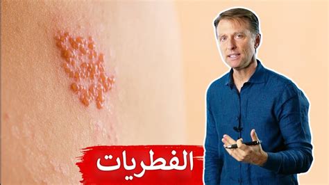 علاج طبيعي لفطريات الجلد الدائرية أو الحلقية Youtube