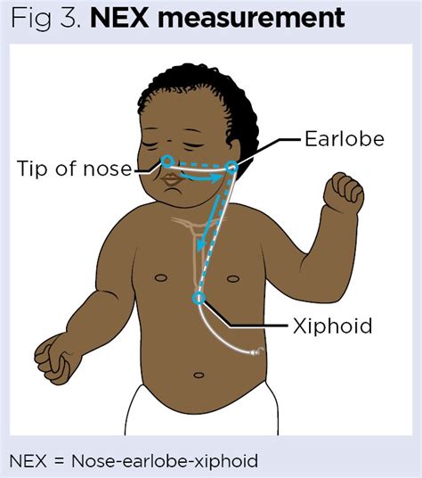 Nasogastric Tube Insertion 1 Children And Young People Nursing Times