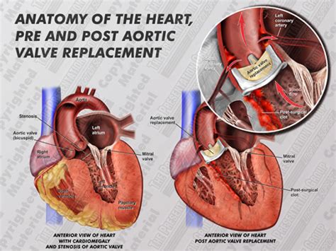 Aortic Valve Replacement Medical Legal Illustration