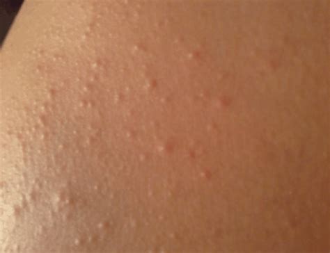 White Spots On Legs Dry Spots Itchy Blood Circulation Thighs