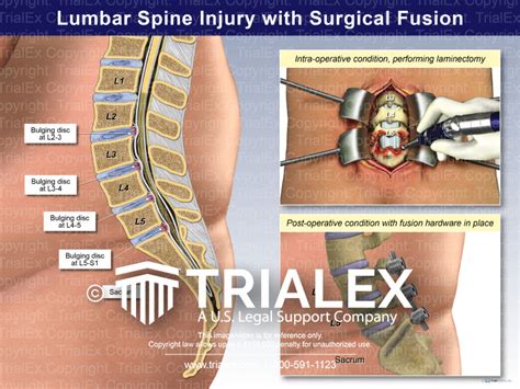 Lumbar Spine Injury With Surgical Fusion Trialexhibits Inc