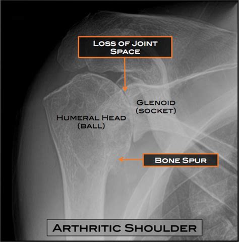 Shoulder Arthritis Austin Tx Shoulder Surgery Austin Tx