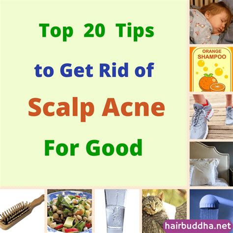 Top 20 Tips To Get Rid Of Scalp Acne Scalp Acne Back Acne Treatment