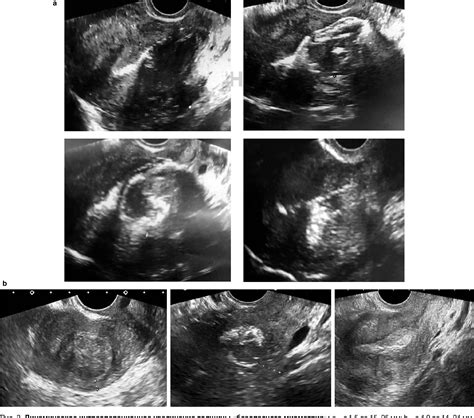 Figure 3 From Ultrasound Assessment Of The Uterine Wall After