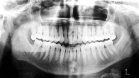 Peripheral Ameloblastoma Presenting As A Pyogenic Granuloma A Case