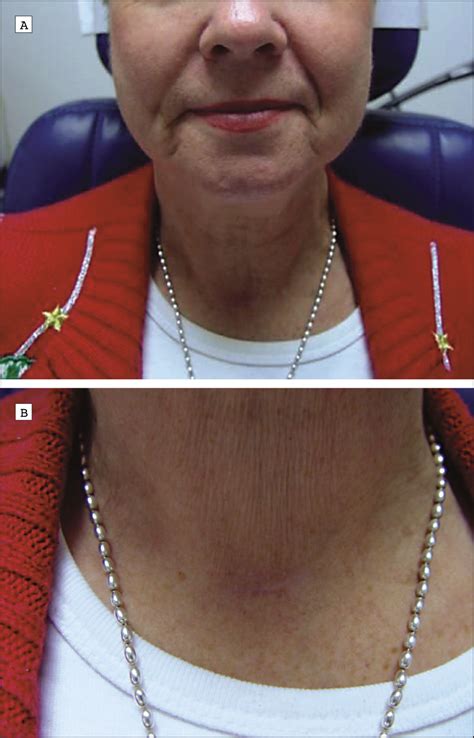 Minimally Invasive Video Assisted Thyroidectomy A Multi Institutional