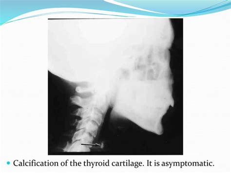 Soft Tissue Calcification Of Head And Neck Ppt