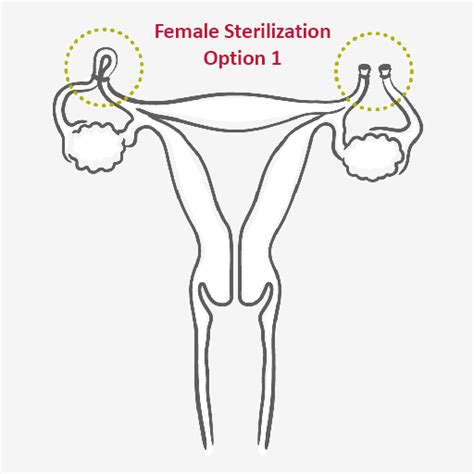 Sterilization Permanent Method