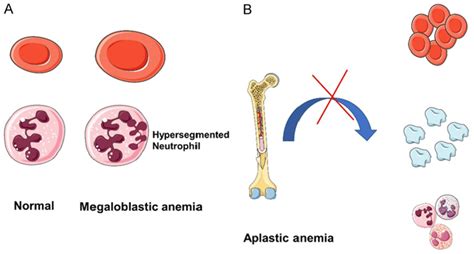 Megaloblastic And Aplastic Anemias Download Scientific Diagram