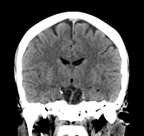 Normal Ct Brain Pre And Post Contrast Image