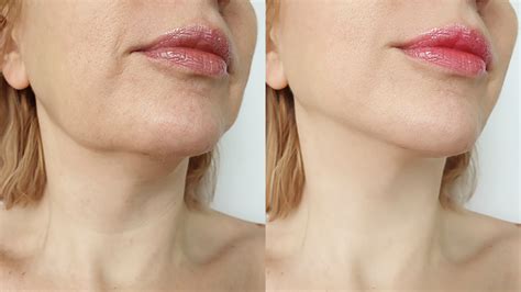 Lymph Drainage Face Before After Best Drain Photos Primagemorg