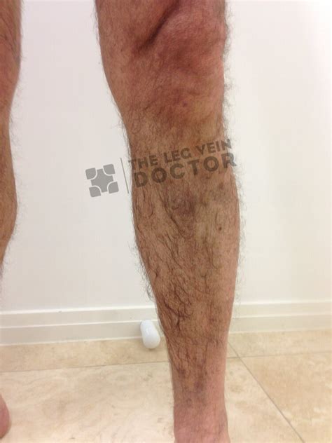 Varicose Vein Results And Post Treatment Photos — The Leg Vein Doctor Brisbane Varicose And