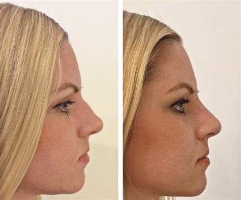 This Non Surgical Technique Allows You To Get A Nose Job In 5 Minutes