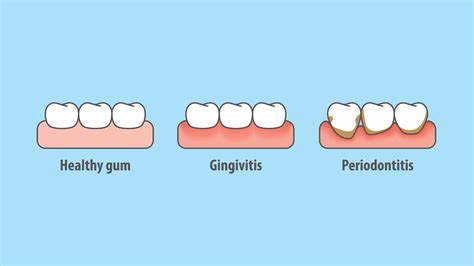 5 warning signs of gum disease that you should look out for nutrition line