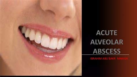 Acute Alveolar Abscess