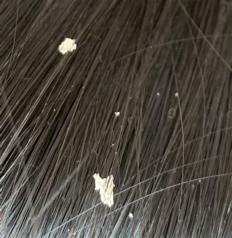 What Kind Of Flake Is This Scalp Or Dandruff Forms After Every Hair