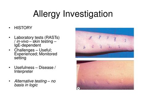 Ppt Allergy And Allergic Diseases Powerpoint Presentation Free
