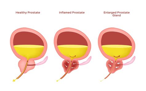 Enlarged Prostate