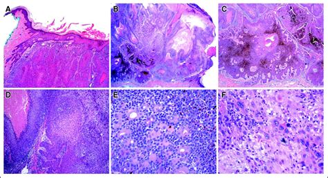 Metastatic Eccrine Porocarcinoma After Mohs Micrographic Surgery A