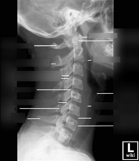 Cervical Spine Lateral View2 Diagram Quizlet