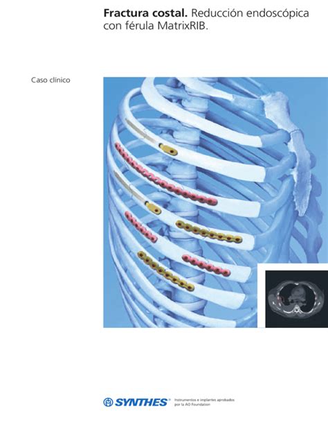 Fractura costal Reducción endoscópica con férula