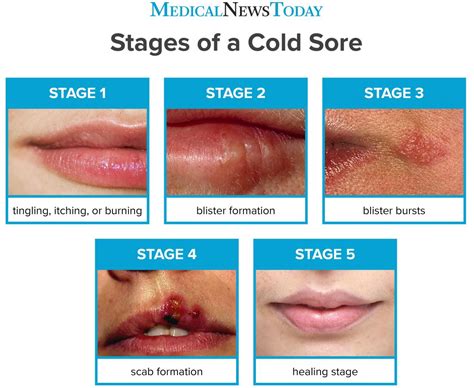 Cold Sore Stages Pictures Duration And Treatment