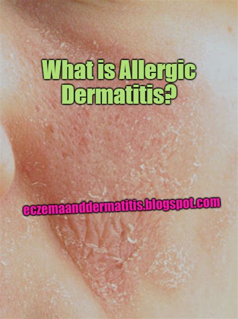 What Is Allergic Dermatitis Eczema And Dermatitis