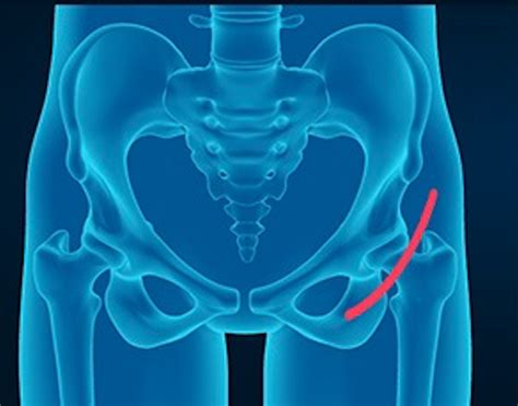 Anterior Approach For Hip Replacement Advantages And Disadvantages