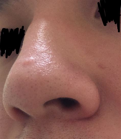 Raised Scar On Nose How Can I Get Rid Of Itw Pics Scar Treatments
