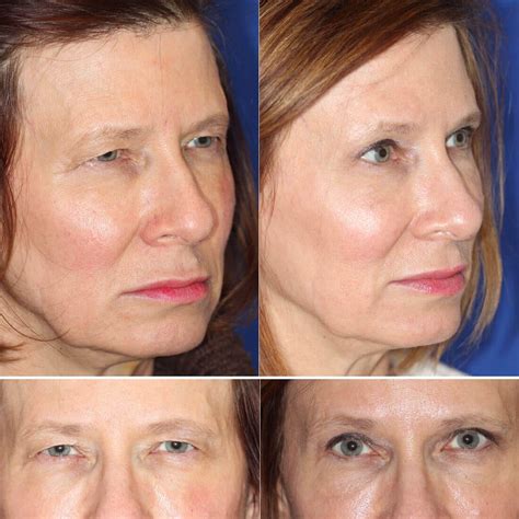 Upper Eyelid And Brow Lift Surgery Dr Dara Liotta