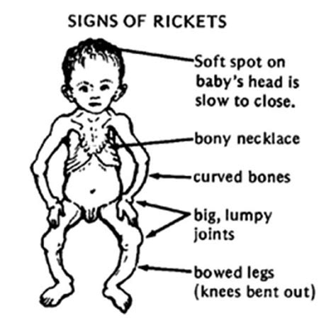 Signs And Symptoms Of Rickets In Children Vitamin D Deficiency Bone
