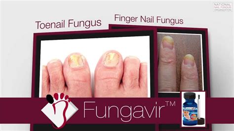 Fungavir Review Toenail Fungus Treatment Review Youtube
