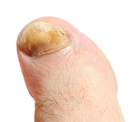 Fungal Infections As Related To Nail Fungus Pictures