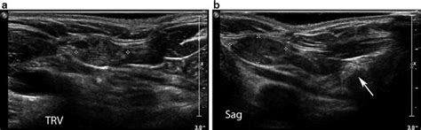 Parathyroid Ultrasound Imaging Pearls Pitfalls And Tips Radiology Key