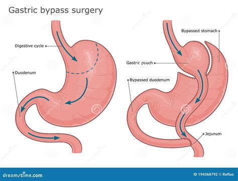 Chirurgia Di Bypass Gastrico Illustrazione Vettoriale Illustrazione Di Schema Grasso 194368792