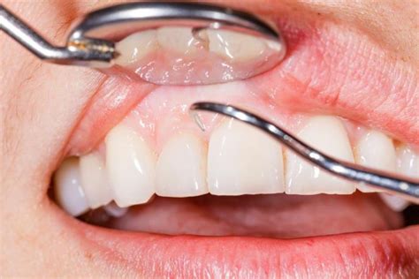 Currently, llcs can submit termination forms online. How long does it take for your gums to heal after tooth ...