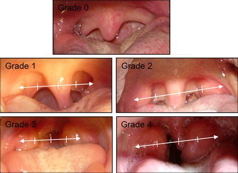 Influence Of Tonsillar Grade On The Dental Arch Measurements American