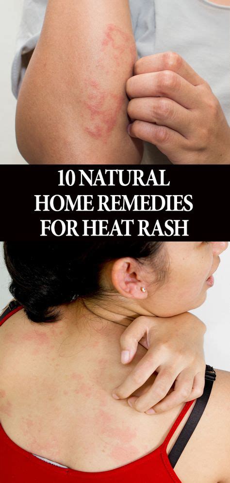 10 Natural Home Remedies For Heat Rash Prevention Tips In 2020 Heat Rash Home Remedies For