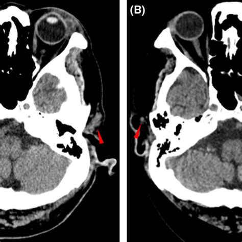 Transverse Noncontrast‐enhanced Computed Tomography Images Of The Head