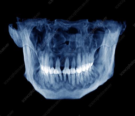Cemental Dysplasia Ct Scan Stock Image M7820244 Science Photo Library